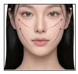 保媄妍美人線|埋線拉提|無痕筋膜拉提 無痕筋膜拉提,胃肉毒,逆時針,抽脂,Onda超微波