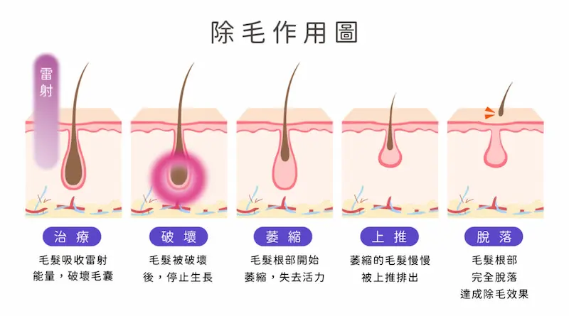 雷射除毛