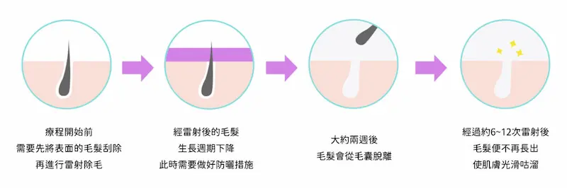 雷射除毛