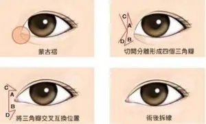 台中開眼頭手術