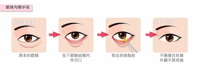 台中眼袋手術3m
