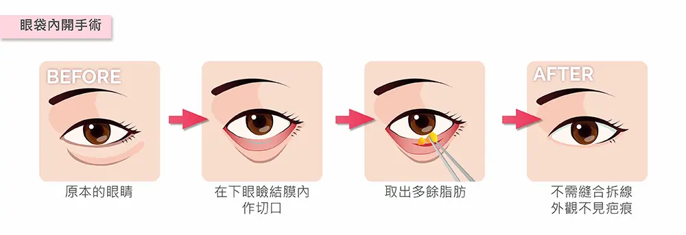 台中眼袋手術3