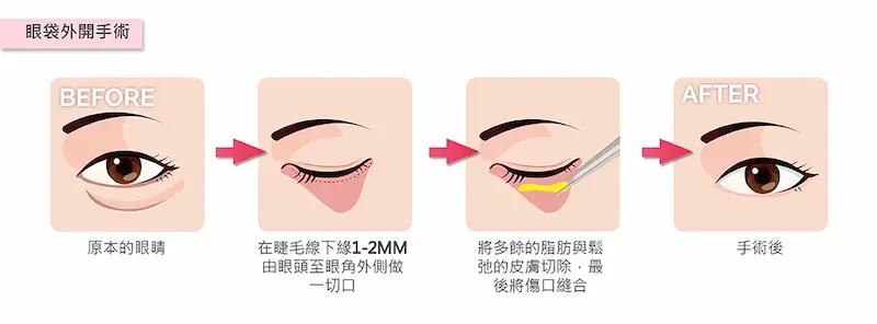 台中眼袋手術4m