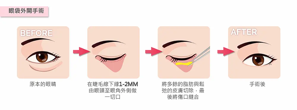 台中眼袋手術4