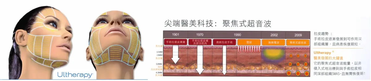 Ulthera極線音波拉提 Ulthera極線音波拉提 台中胃肉毒,玩美電波,電音波拉提,玻尿酸,皮秒雷射|台中瑞星診所