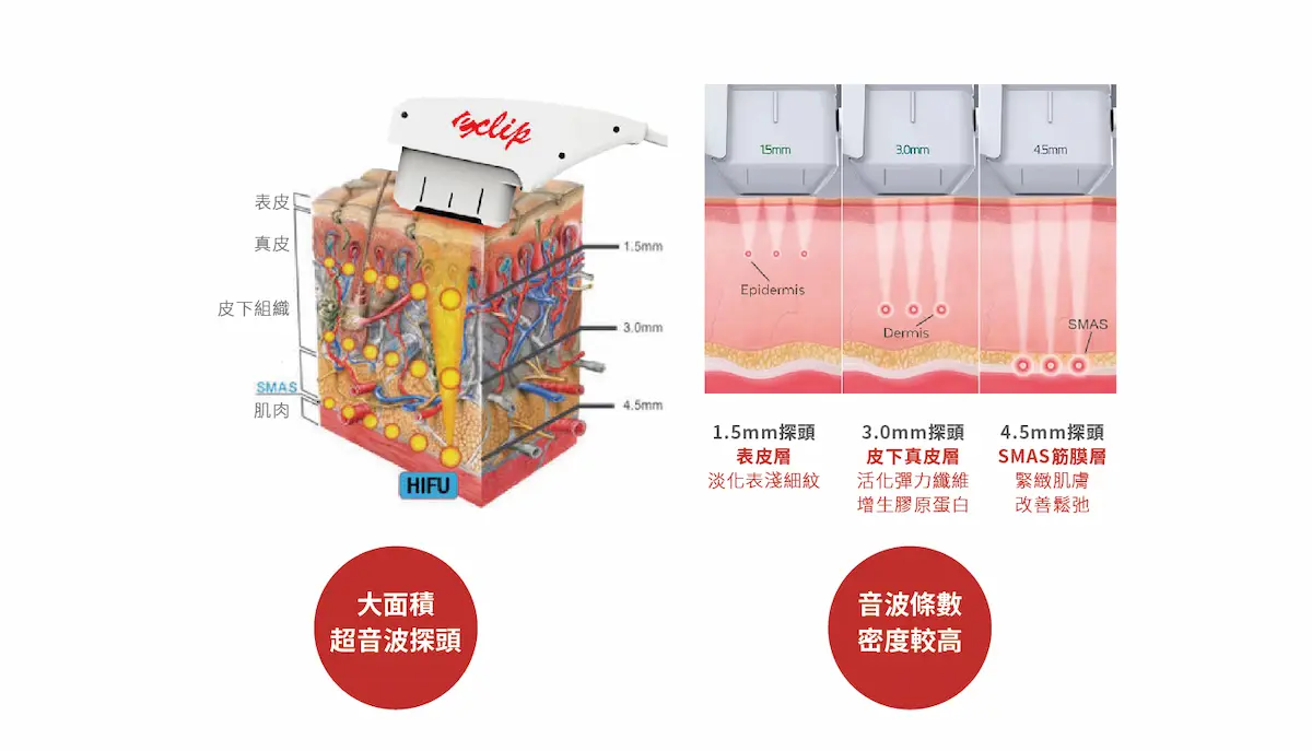 E‑Clip立提音波 無痕筋膜拉提,飛梭雷射,胃肉毒,醫美診所,整形