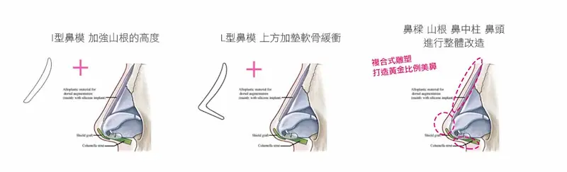 三段式隆鼻 無痕筋膜拉提,飛梭雷射,胃肉毒,醫美診所,整形