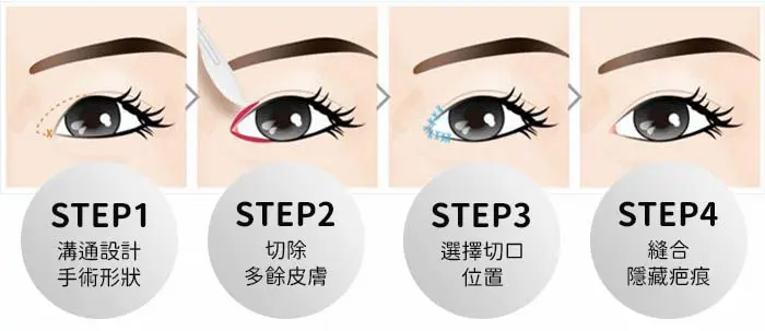3D無痕雙眼皮手術 無痕筋膜拉提,胃肉毒,醫美診所,整形