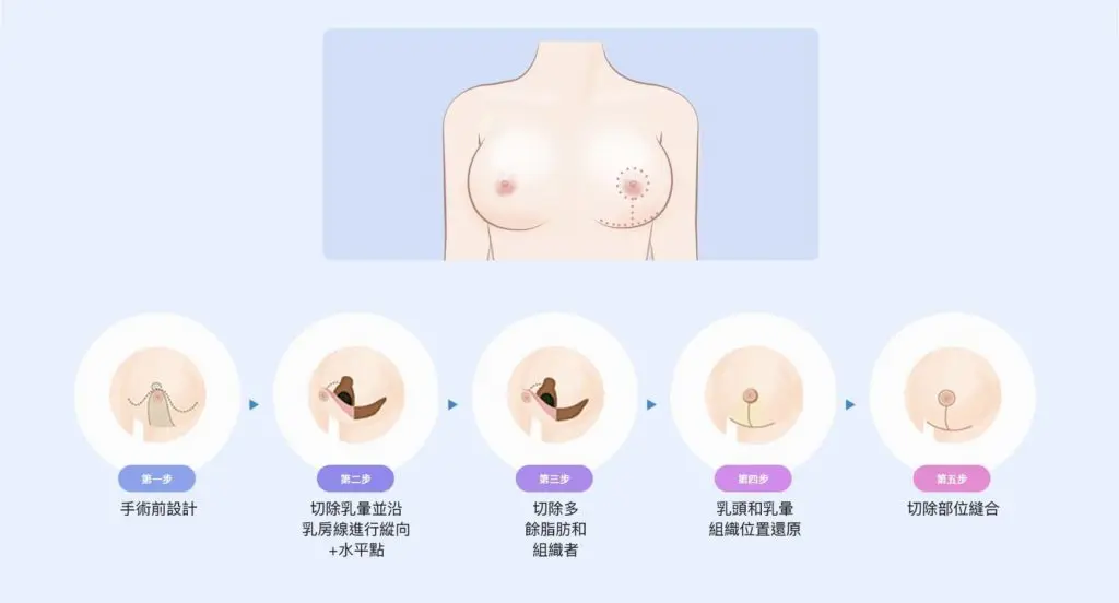 乳房縮胸手術 無痕筋膜拉提,飛梭雷射,胃肉毒,醫美診所,整形