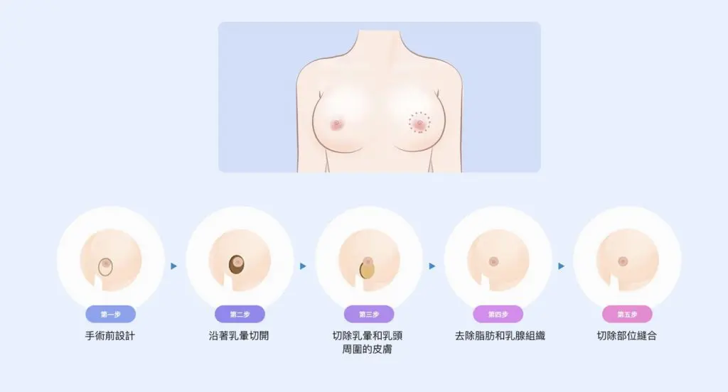 乳房縮胸手術 無痕筋膜拉提,飛梭雷射,胃肉毒,醫美診所,整形