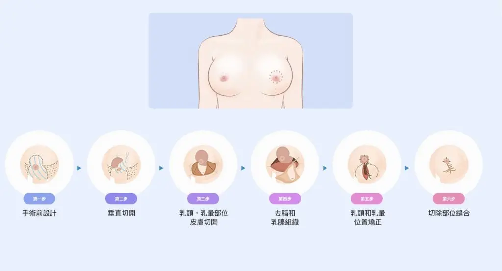 乳房縮胸手術