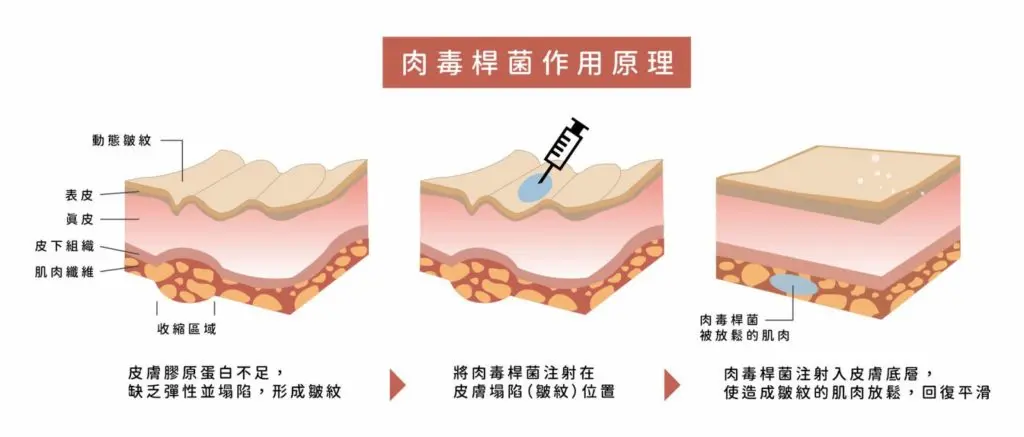 台中肉毒桿菌除皺2