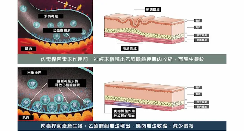 台中肉毒桿菌除皺3m