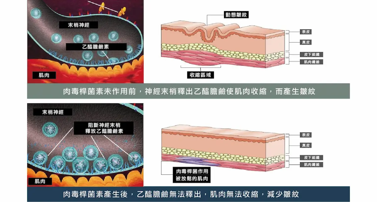 台中肉毒桿菌除皺3